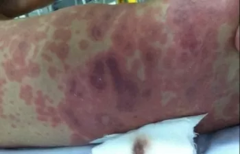 Cập nhật mới nhất tình hình ca viêm não ở Thái Bình